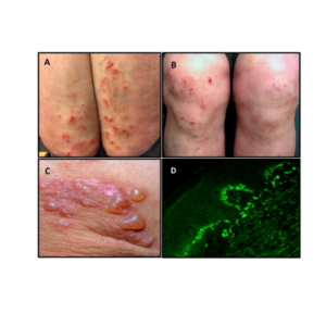 Enfermedad Celíaca y Dermatitis Herpetiforme 1